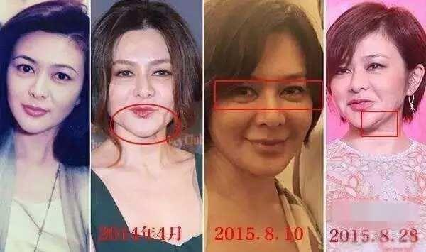 明星下巴玻尿酸,揭秘美丽秘密的神奇魔力